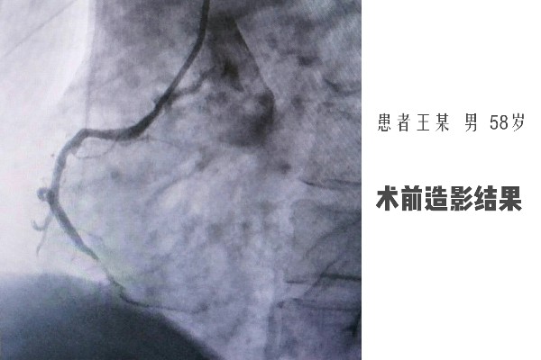 術前造影結果