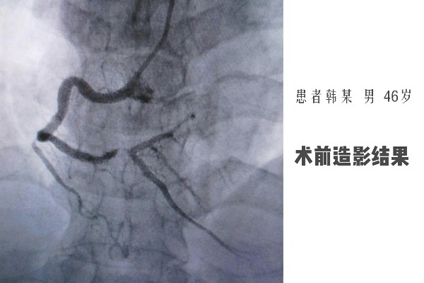 術前造影結果