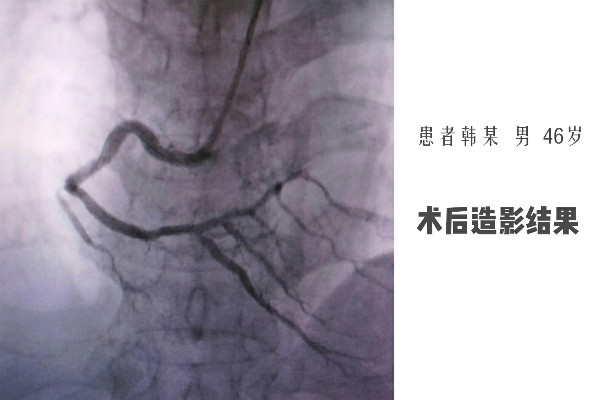 術后造影結果