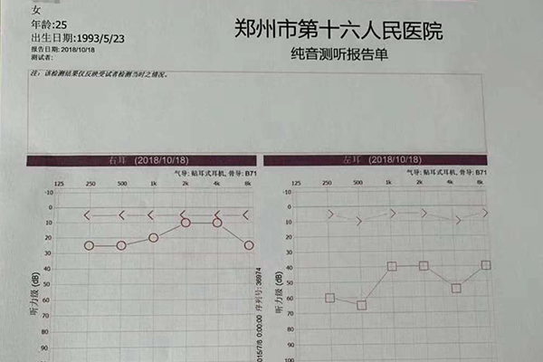 術后復查聽力恢復正常