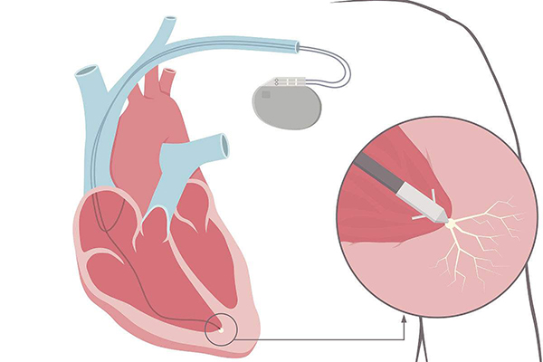 我院成功為耋耄老人置換心臟起搏器