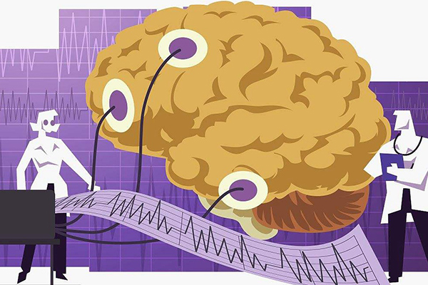 視頻腦電圖診斷癲癇性腦病