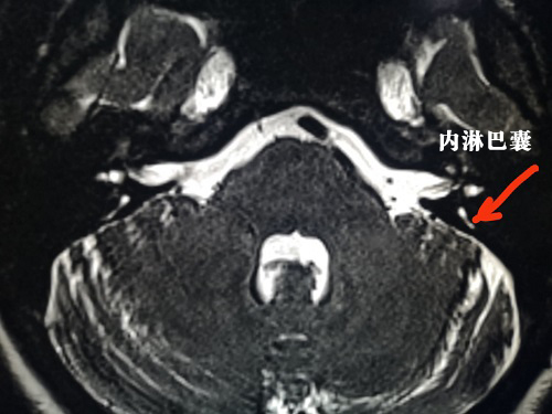 我院耳鼻喉科成功治療梅尼埃病三期患者