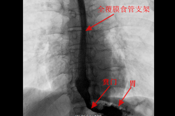 食道全覆膜氣管支架植入術解決患者進食嗆咳痛苦