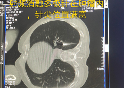 射頻消融多極針在腫瘤內