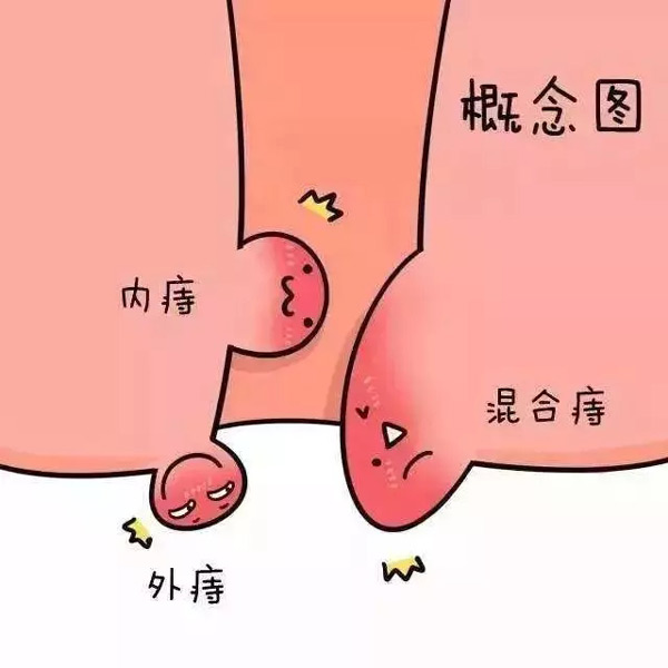 痔瘡概念圖