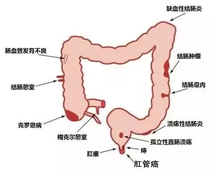 肛腸疾病錯誤認知問題