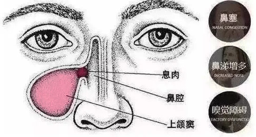 鼻息肉有哪些癥狀表現？