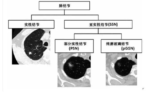 肺結節就是肺癌嗎？