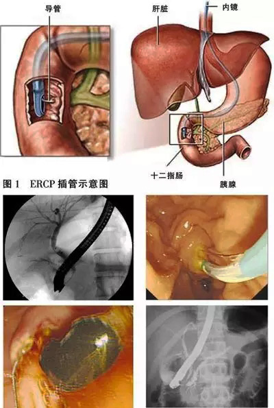 ERCP技術