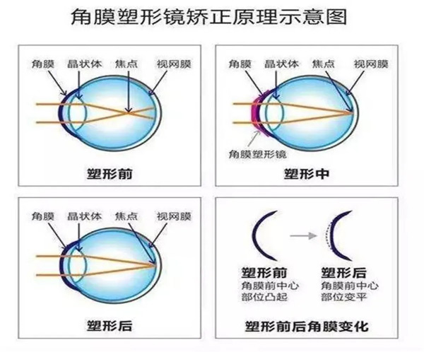 “C位出道”的角膜塑形鏡到底是什么？