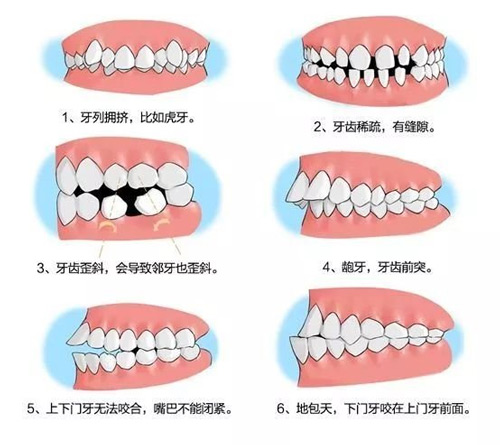 兒童牙齒矯正的黃金時機是什么時候？