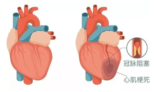 5種信號提示心肌梗死發作 10個時段需要格外警惕
