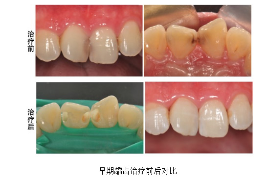 蛀牙真的是牙被蟲蛀了嗎？