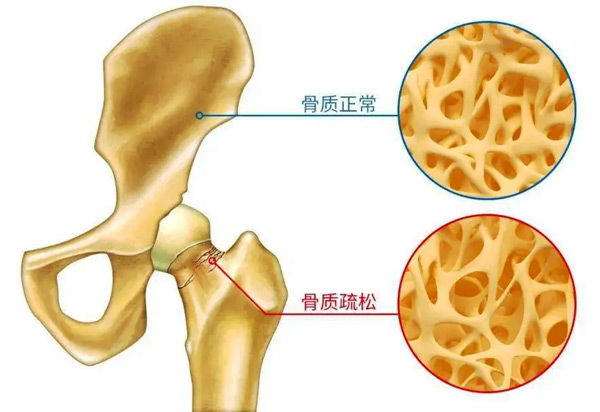 骨質疏松九大常見誤區你了解嗎？