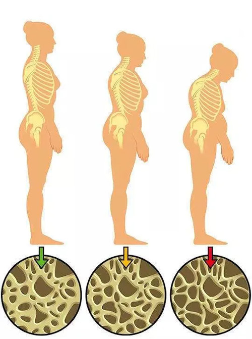 骨質疏松九大常見誤區你了解嗎？