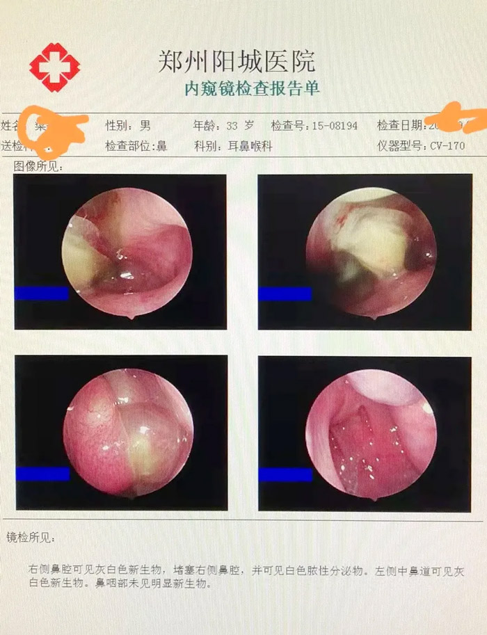 鼻內窺鏡檢查見右側中鼻道新生物