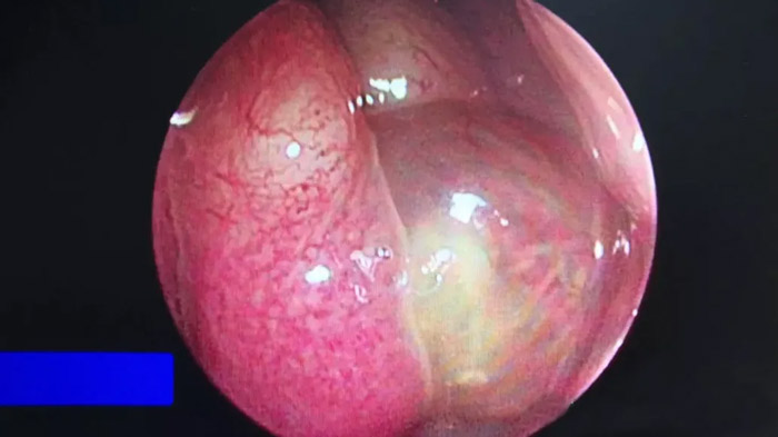 鼻內窺鏡檢查見右側中鼻道新生物