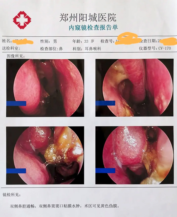 術后一周患者復查鼻內窺鏡：術區恢復可。