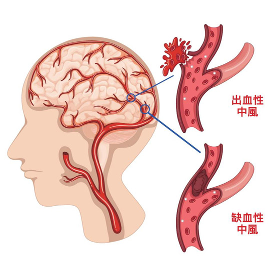 腦中風人群畫像治療費用及預防護理