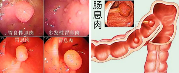 胃腸里長個“小疙瘩”切還是不切？