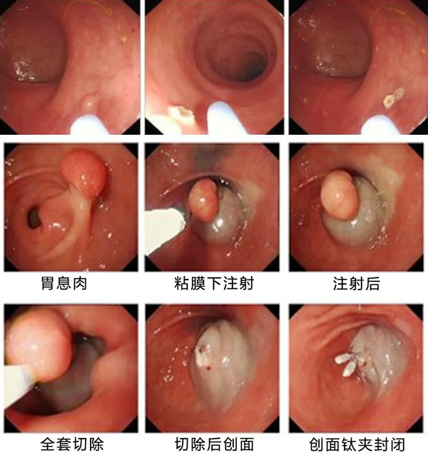 胃腸里長個“小疙瘩”切還是不切？