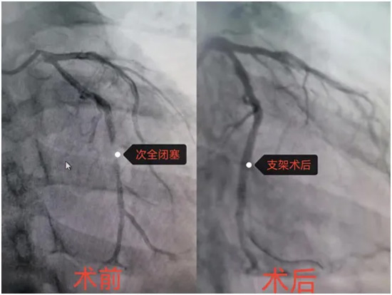 異鄉客突發心梗 陽城醫院把命救