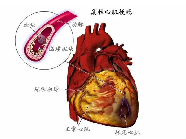 異鄉客突發心梗 陽城醫院把命救