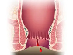 什么是肛裂？什么原因會引起肛裂？