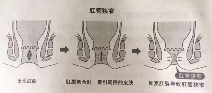 什么是肛裂？什么原因會引起肛裂？