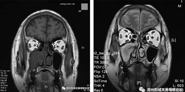 患者嚴重頭痛需手術，心臟嚴重病變風險高，該何去何從？