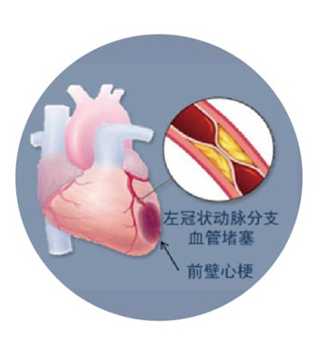 什么是急性心梗