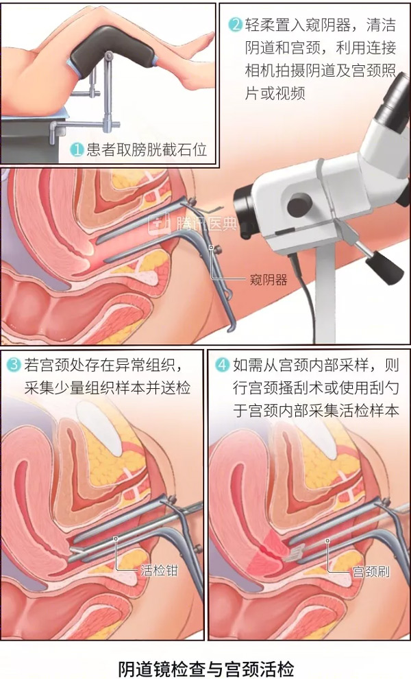 “活檢”是什么？怎么做？