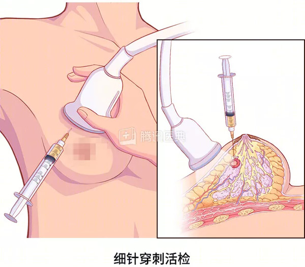 “活檢”是什么？怎么做？