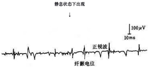 纖顫電位