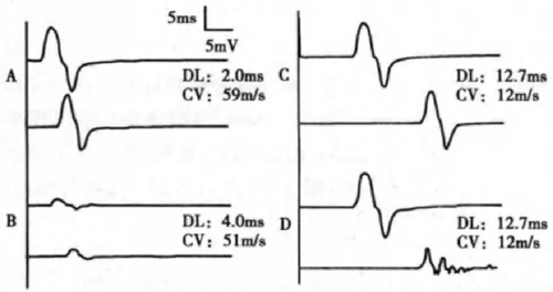 圖 6. A. 正常；B. 軸索變性（波幅明顯降低）；C. 髓鞘脫失（兩條線潛伏期差明顯 ↑，傳導速度 ↓）；D. 髓鞘脫失伴傳導阻滯和波形離散