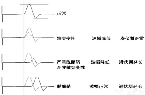 脫髓鞘與軸索損害鑒別