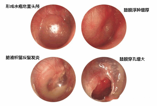 為什么會發生突發性聾？