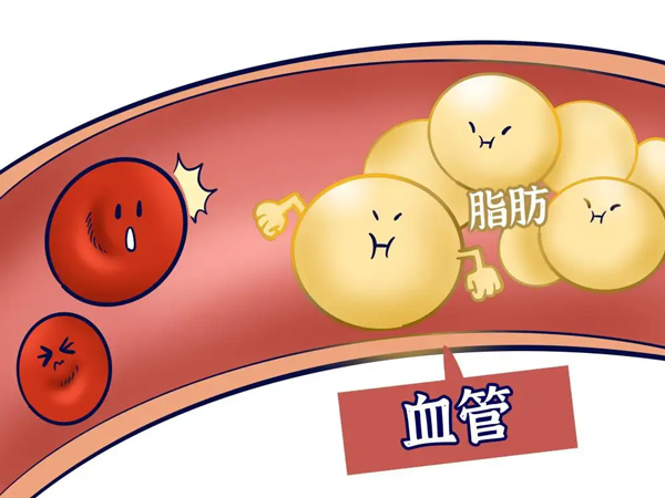 【心腦血管疾病防治行動】這些高血脂的誤區你中了幾個？