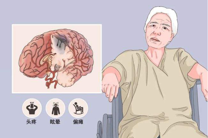 腦卒中的預防與緊急處理