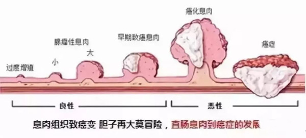 息肉癌變過程