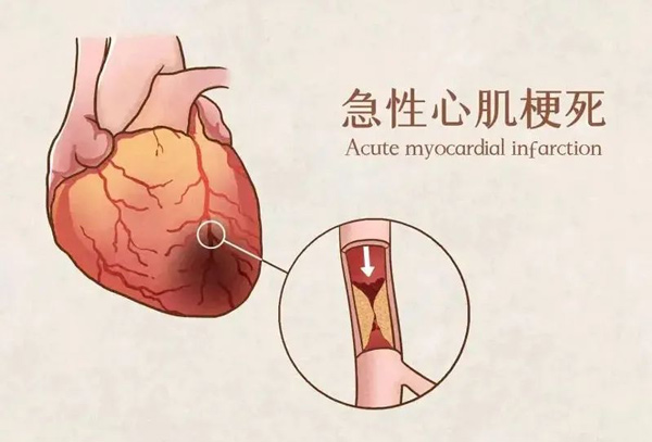 急性心肌梗死頻發，5種信號10個時段要格外警惕！