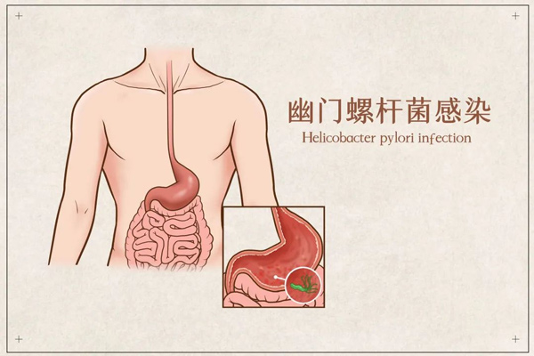 “明確致癌物”幽門螺桿菌的檢查和預防