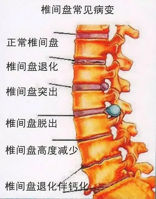 腰椎間盤突出的防治方法一文說清~