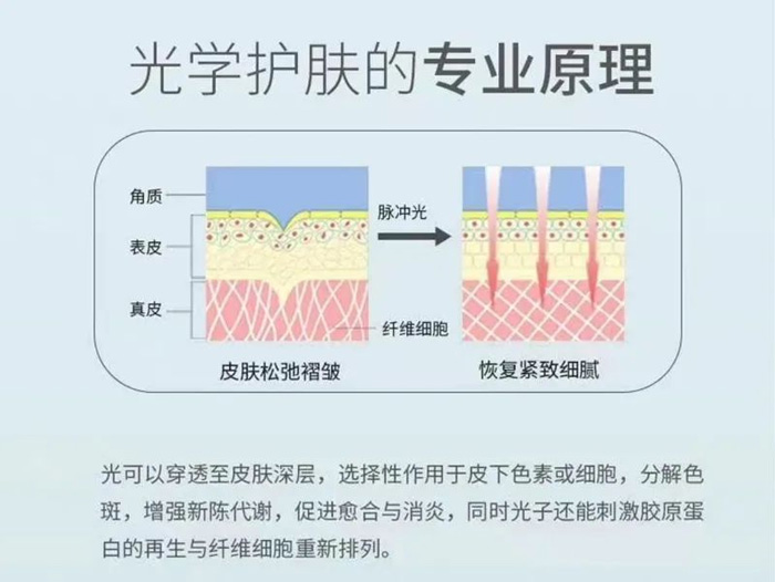 光子嫩膚怎么做？愛美的你要注意這幾點~