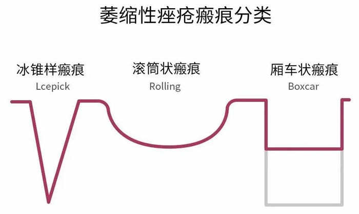 痘坑終結者--點陣激光：在臉上蓋個章，痘坑就平了？