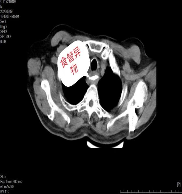 驚險！八旬老人異物卡喉命懸一線，鄭州陽城醫院內鏡團隊巧手取出化險為夷