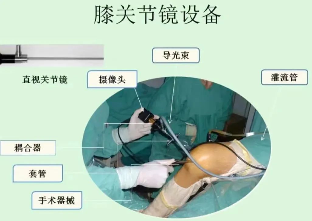 鄭州陽城醫院骨科成熟開展膝關節鏡微創技術！