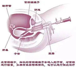 宮腔鏡技術