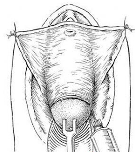 宮腔鏡技術